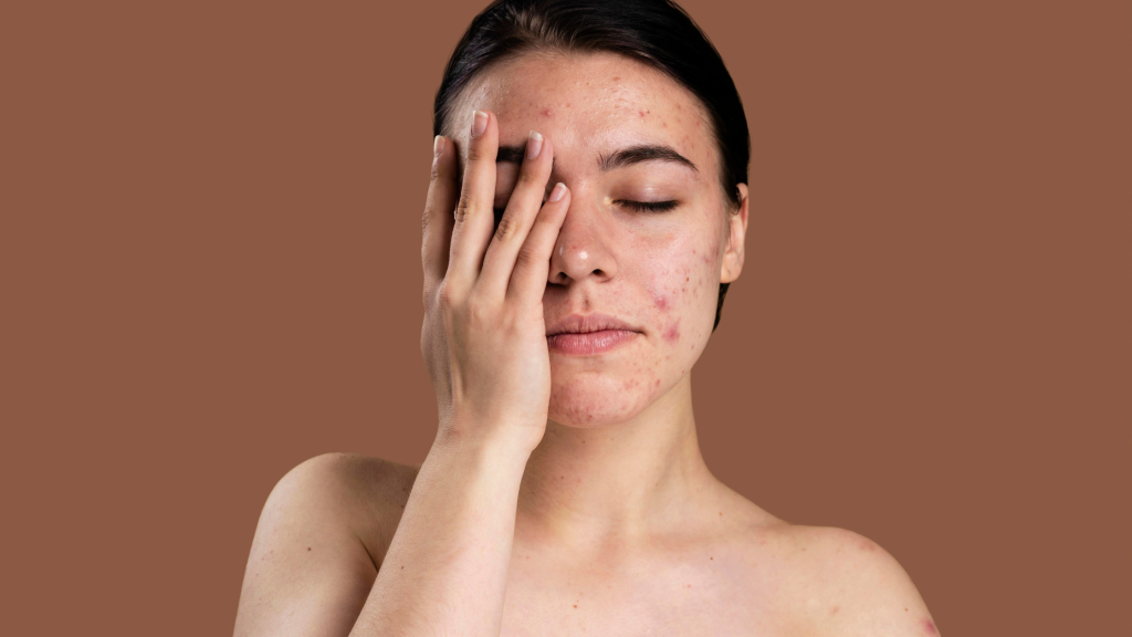 How long does it take for acne to go away?
