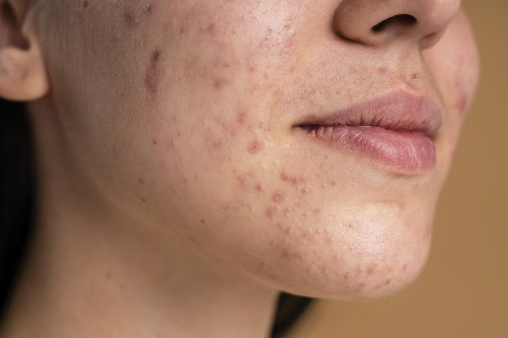 DOES DRY SKIN CAUSE ACNE?